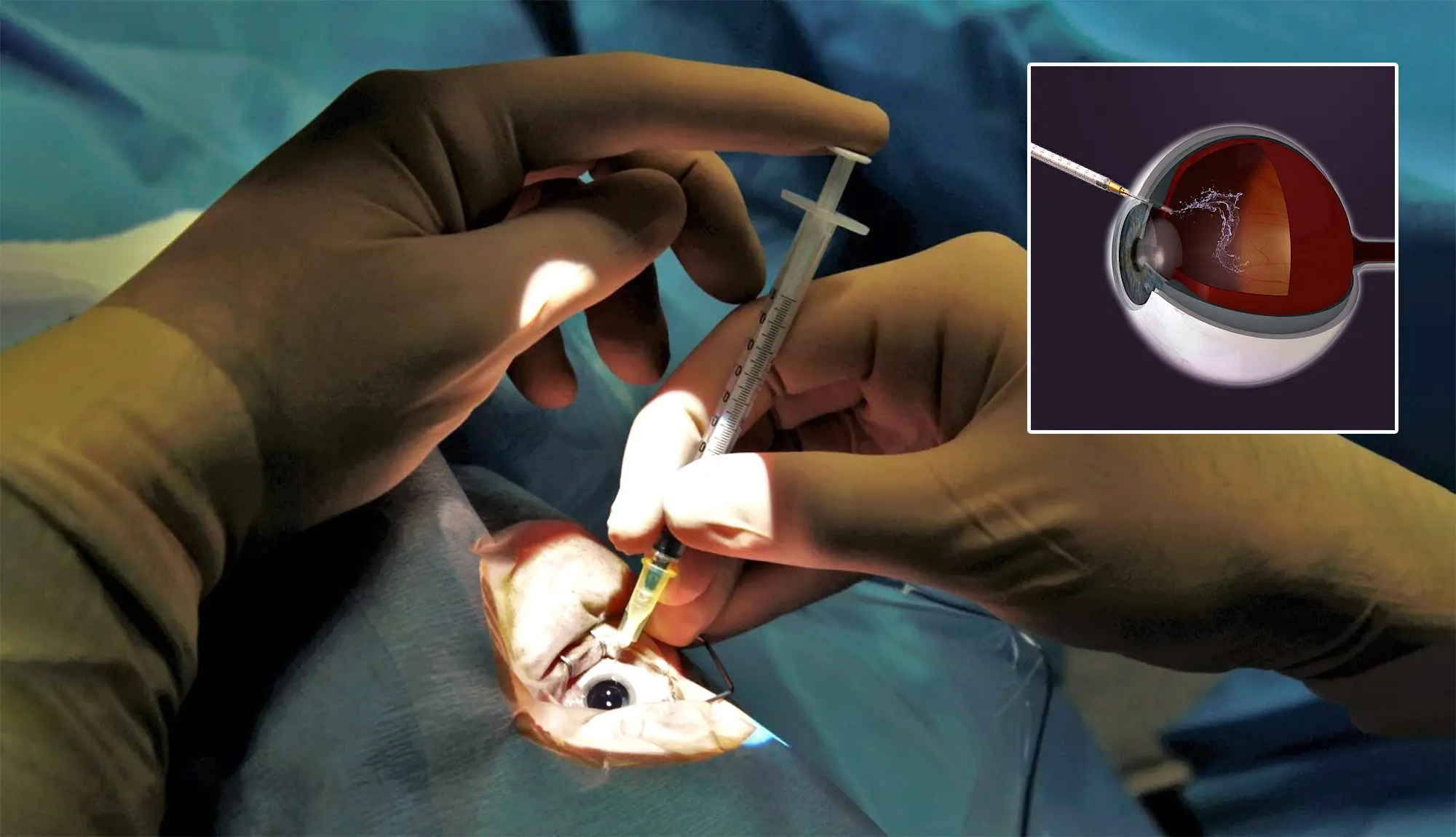 안구 내 주사 치료(IVI) - 황반변성, 당뇨망막병증 실명 예방을 위한 치료 기전, 안전성 및 유전자 치료 혁신 - 100 age health